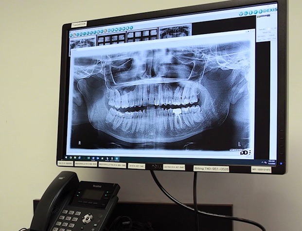 X rays of teeth on computer screen