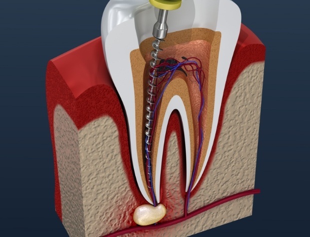 Illustrated dental tool cleaning the inner pulp of a tooth