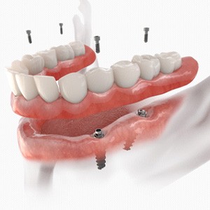diagram of an implant denture with the posts