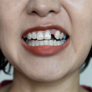 Woman with a missing tooth