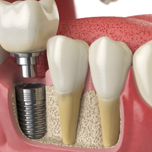 Digital illustration of a dental implant