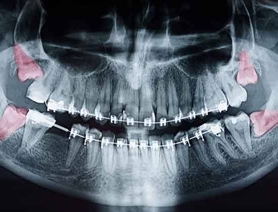 X-ray image with 4 wisdom teeth highlighted red