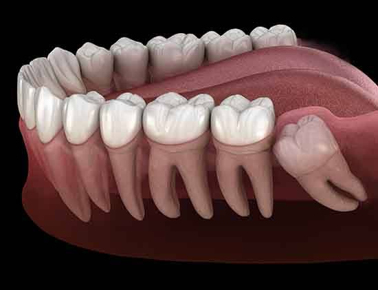 Profile view rendering of a lower set of teeth with an impacted wisdom tooth