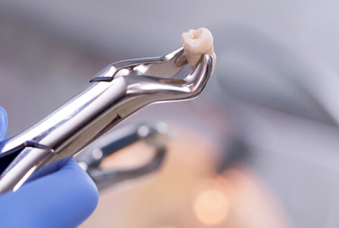 Dental forceps holding an extracted wisdom tooth